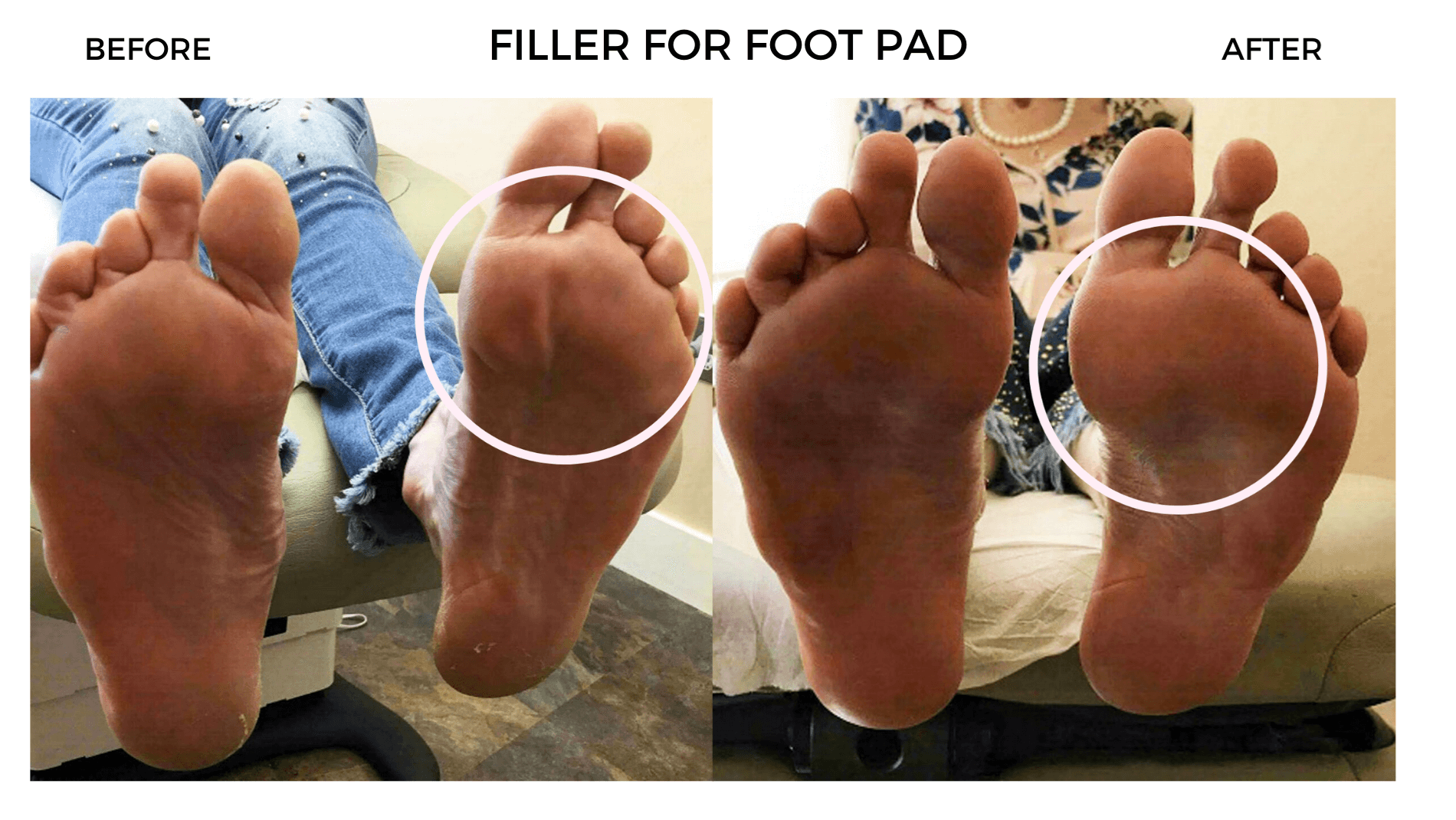 Filler For Foot Pad